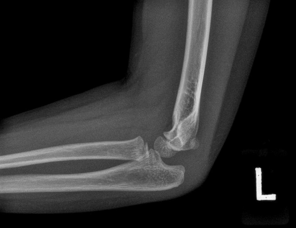 ELBOW JOINT EFFUSION | buyxraysonline