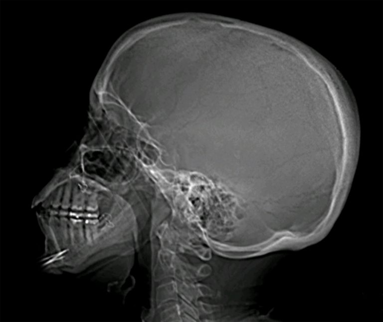 Skull Xrays Lateral View Buyxraysonline