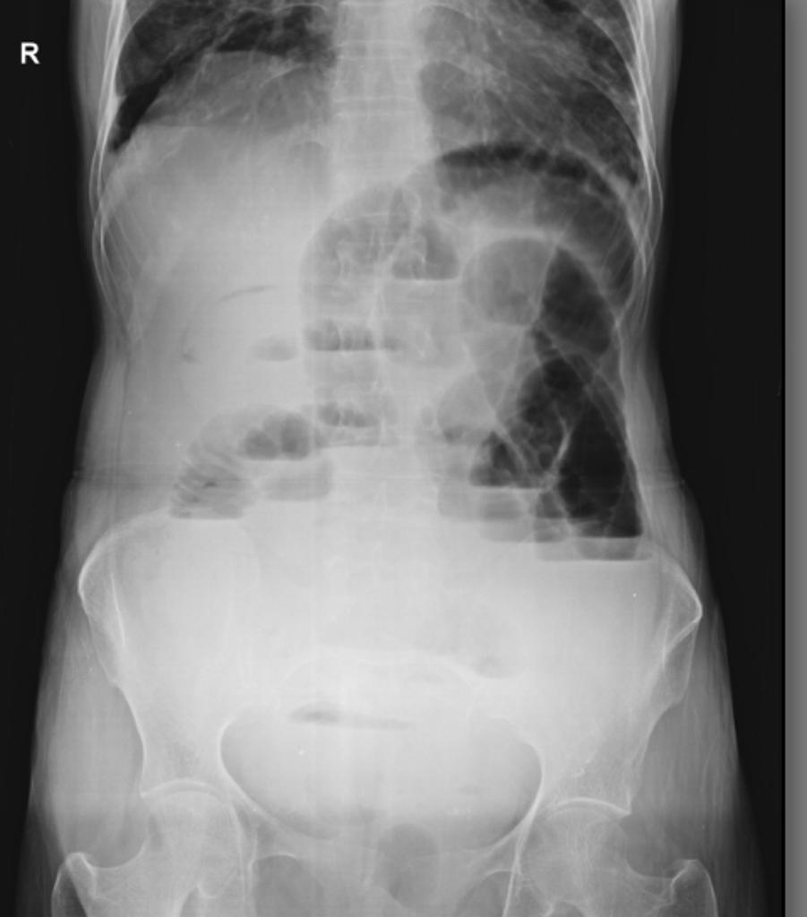 Intestinal Obstruction X Ray