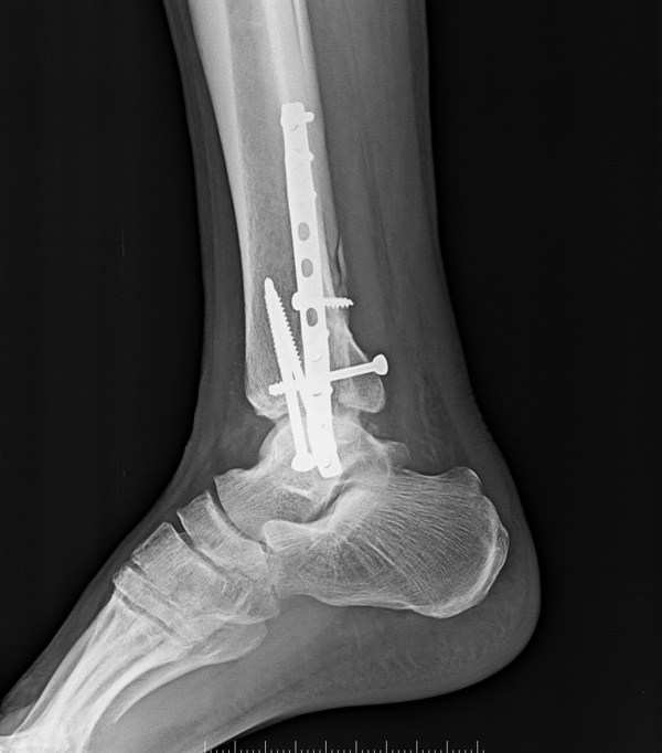 ankle bone fracture