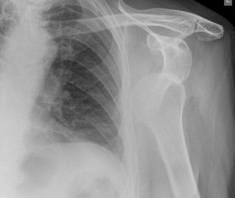 ANTERIOR SHOULDER DISLOCATION | Buyxraysonline