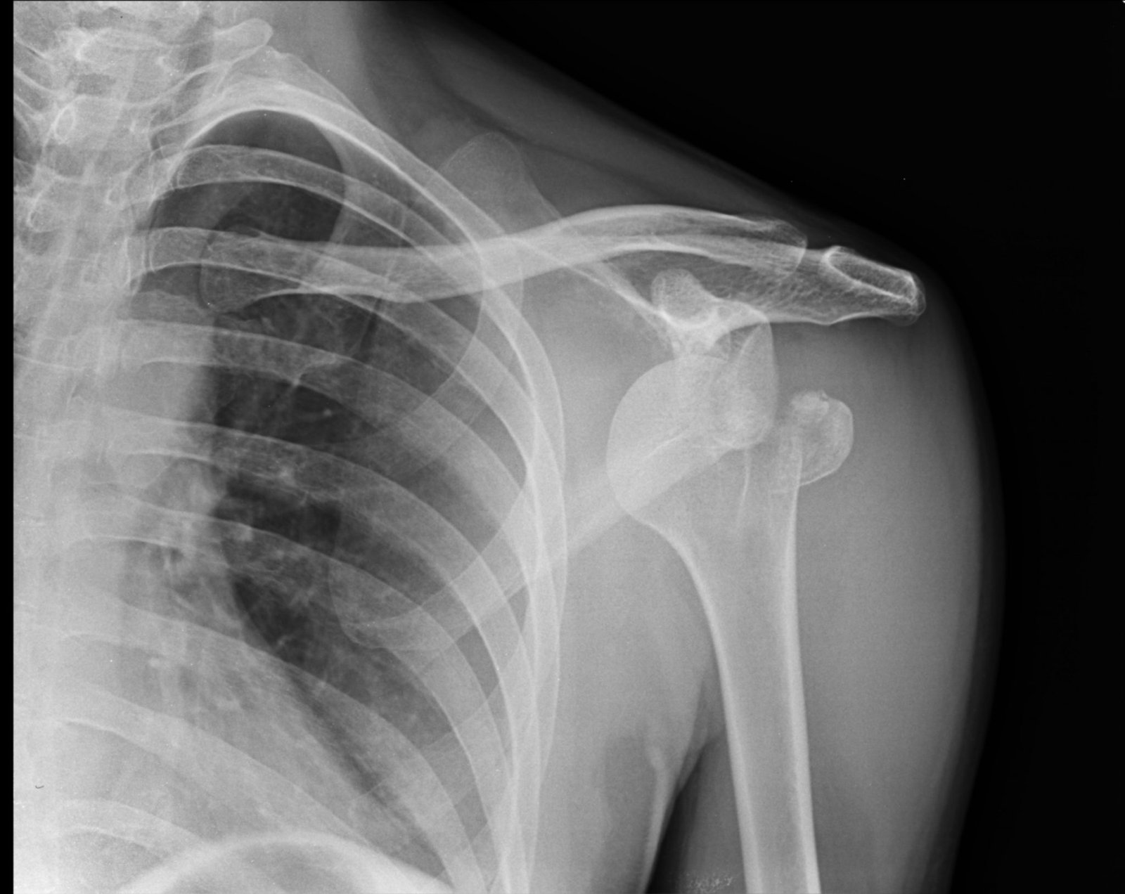 ANTERIOR SHOULDER DISLOCATION WITH FRACTURE Buyxraysonline