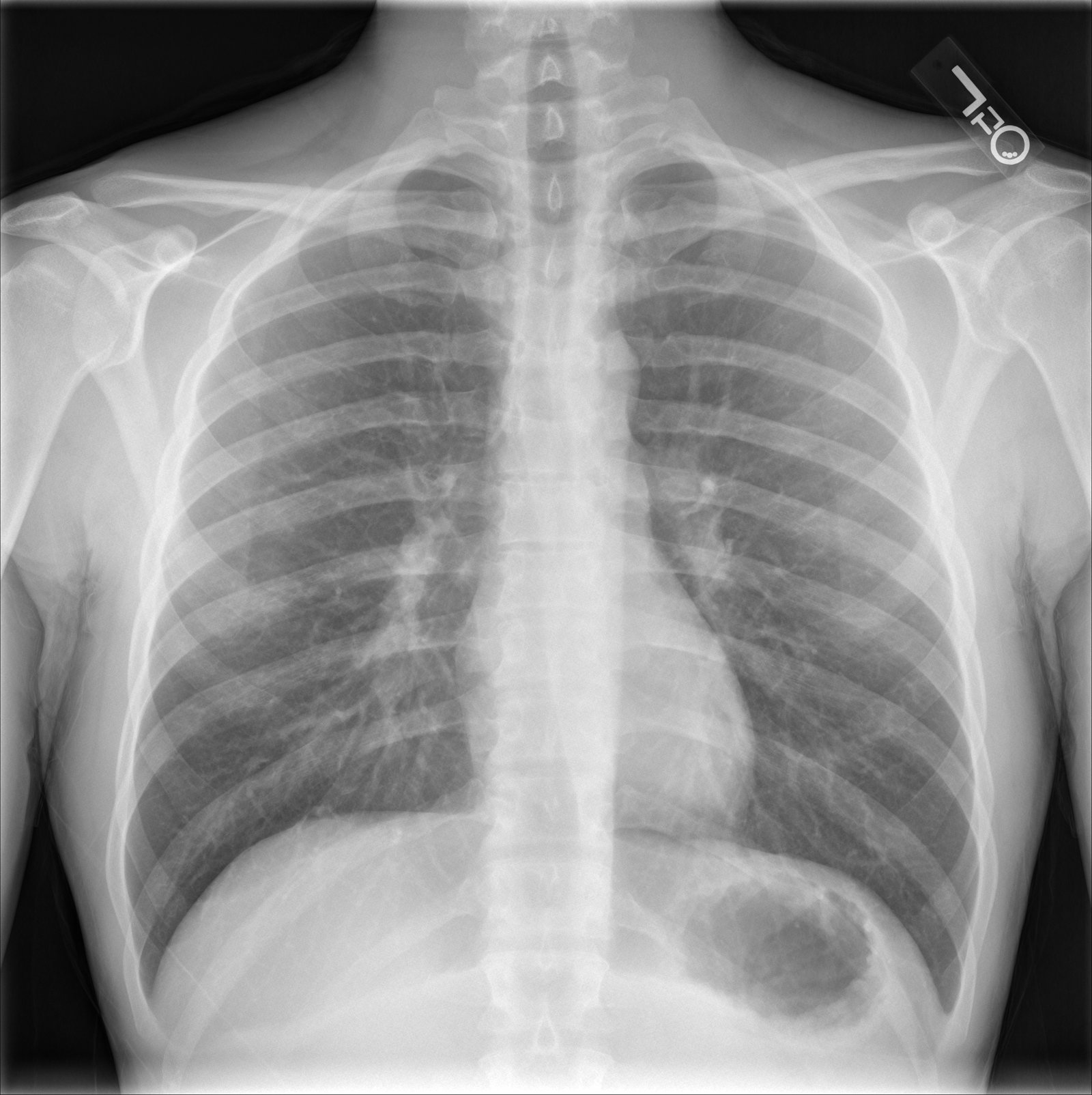 AZYGOESOPHAGEAL STRIPE | buyxraysonline