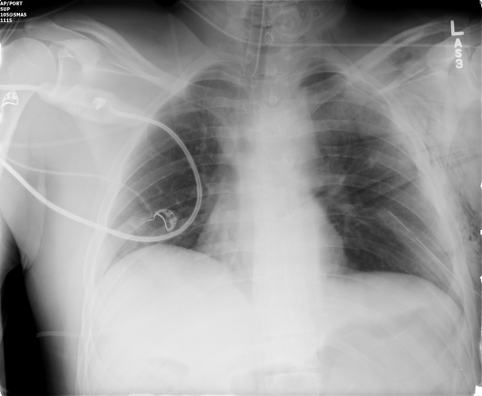 BLUNT AORTIC INJURY | buyxraysonline