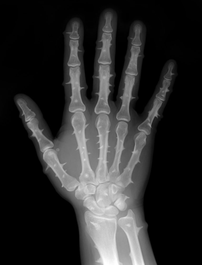 CACTUS DISEASE | Buyxraysonline