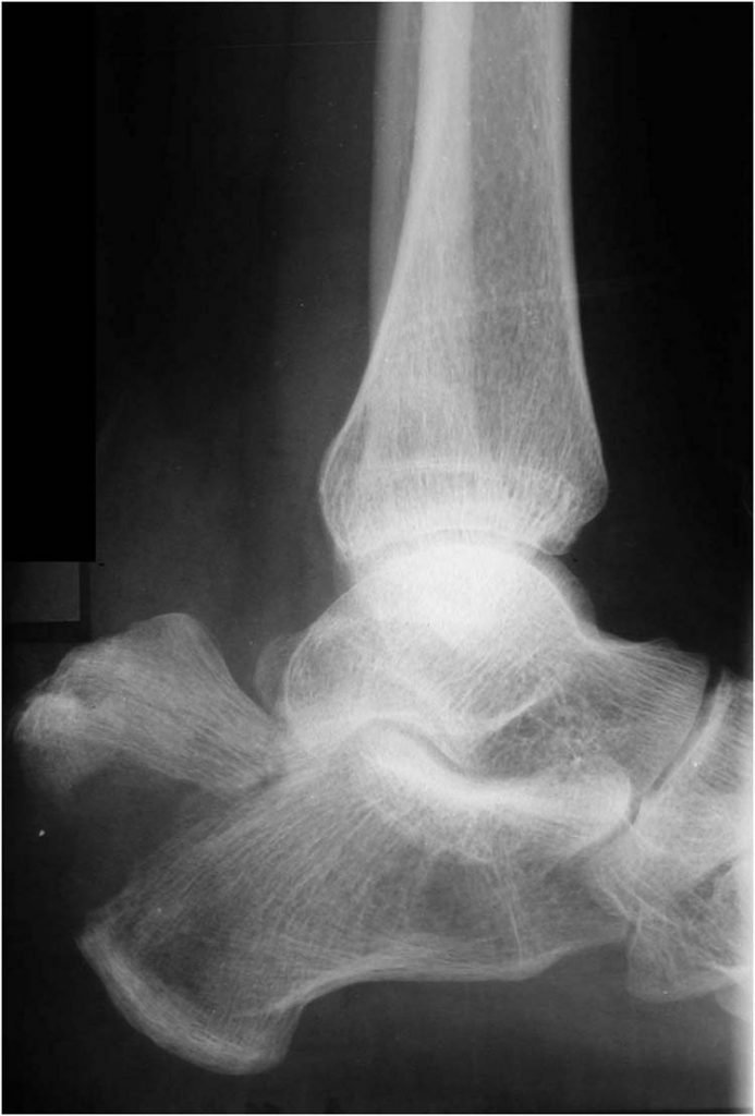 icd 10 code for left calcaneal avulsion fracture