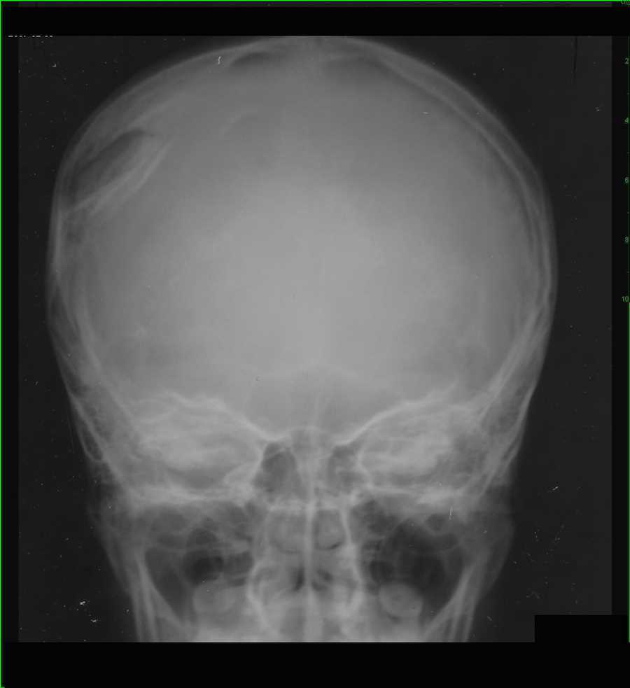 DEPRESSED SKULL FRACTURE Buyxraysonline