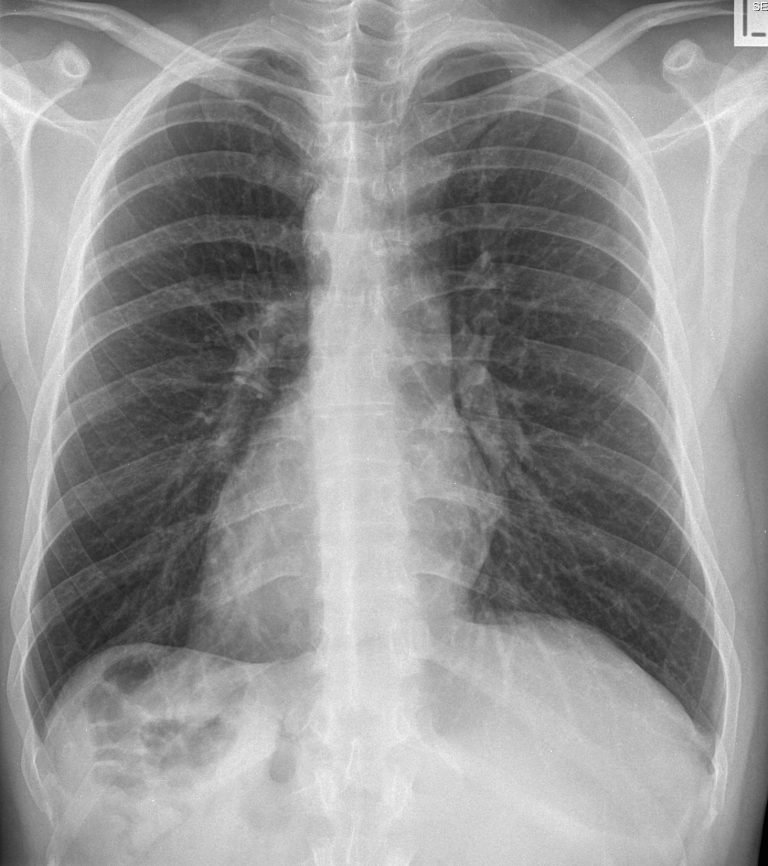 DEXTROCARDIA 2 | Buyxraysonline