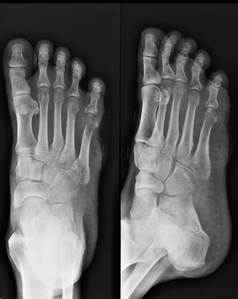 DIABETIC FOOT | Buyxraysonline