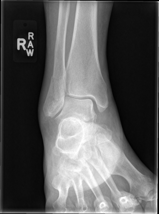 icd 10 code for right distal fibula fracture