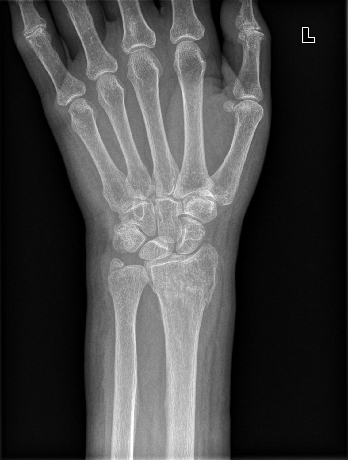 icd 10 code for right distal radius fracture