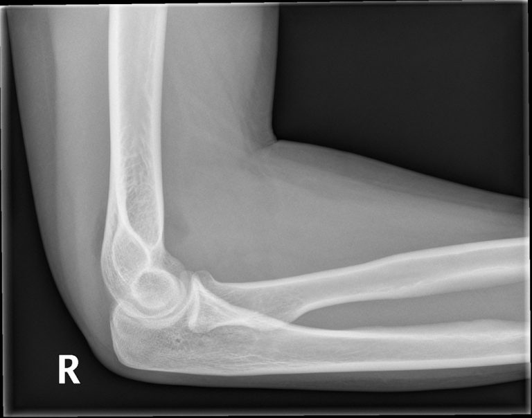 Elbow Joint Effusion Buyxraysonline 9834