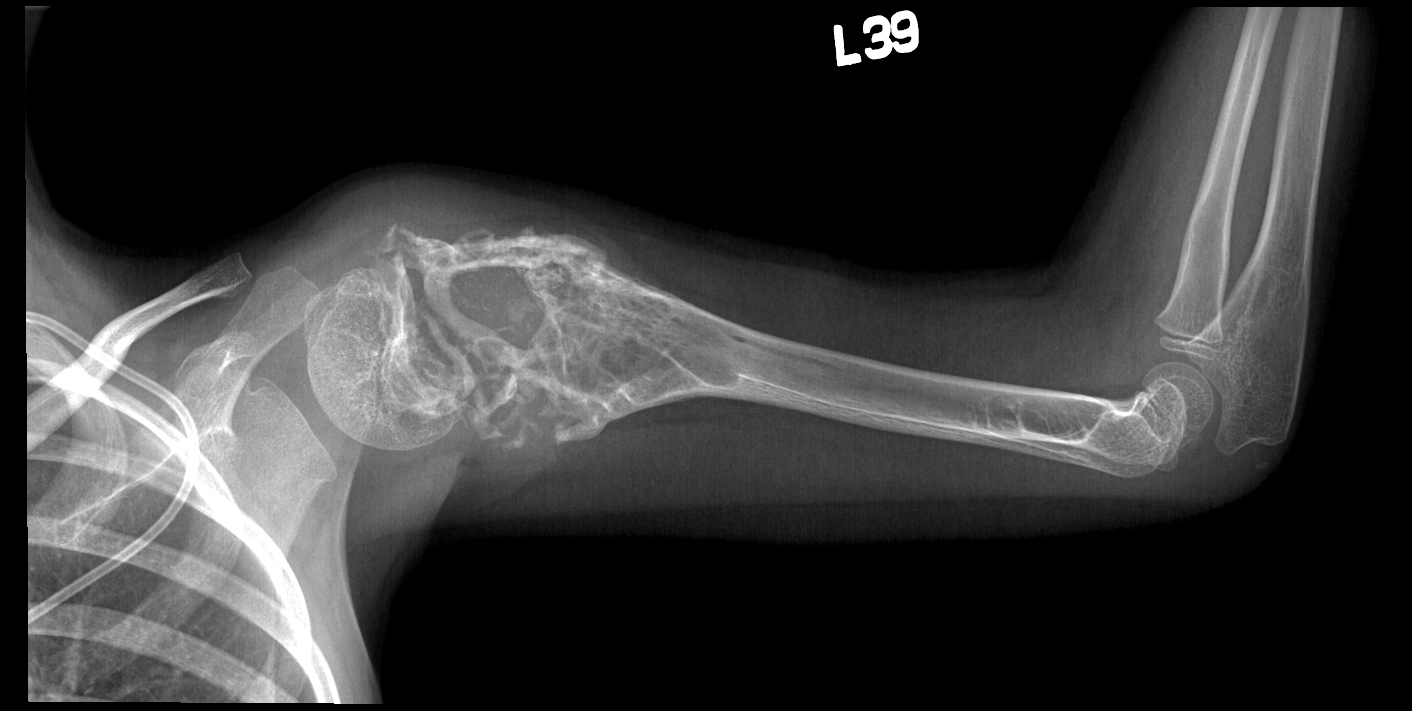 Рак кости ноги. Остеосаркома плечевой кости рентген. Саркома Эвинга плечевой кости рентген. Хондросаркома плечевой кости рентген.
