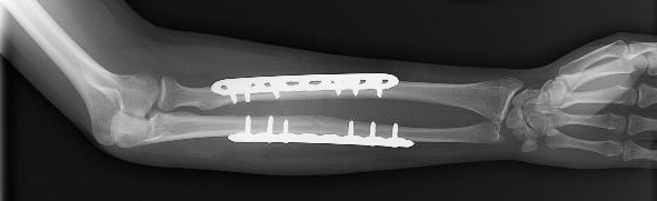 Forearm Fractures Fixed Buyxraysonline