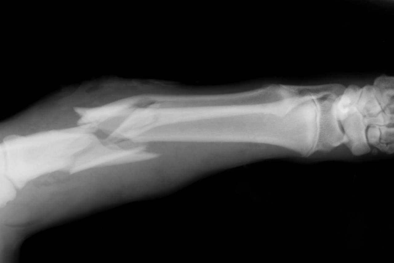 Открытая трещина. Рентгенограмма перелом кости. Перелом берцовой кости рентген. Открытый перелом рентген.