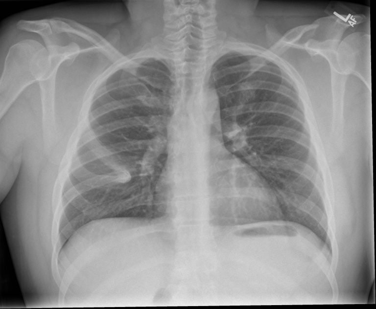 FUSED RIB | Buyxraysonline