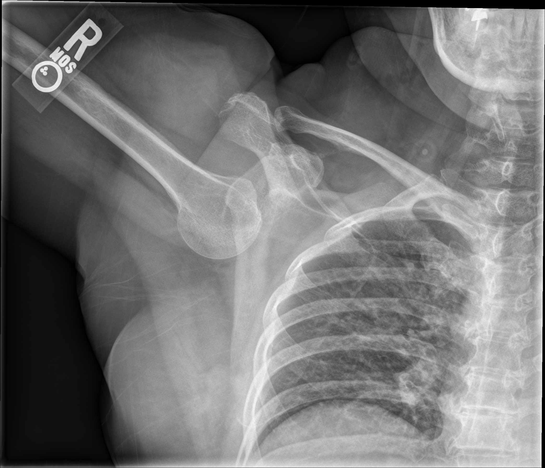 GLENOHUMERAL JOINT DISLOCATION | Buyxraysonline