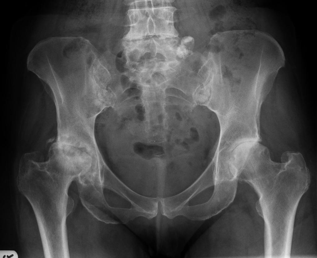 normal xray hip 14 years old