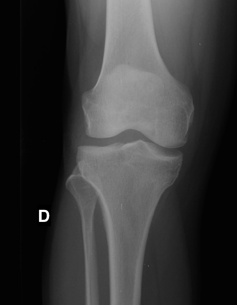 KNEE JOINT EFFUSION Buyxraysonline