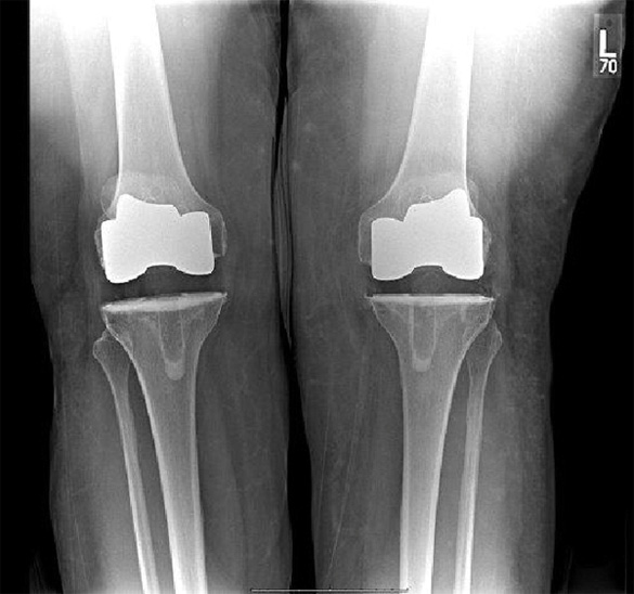 Knee Prosthesis Buyxraysonline