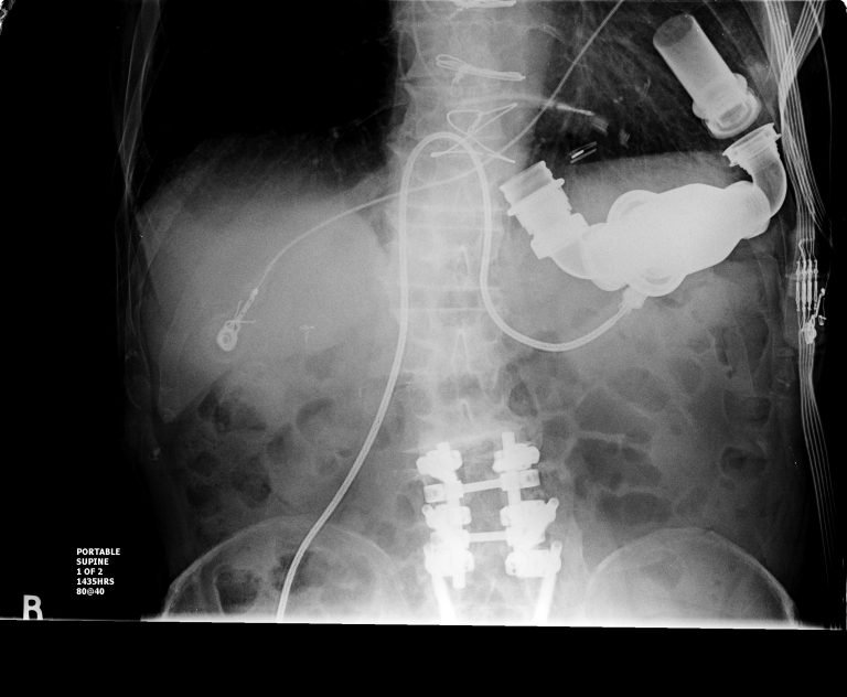 Left Ventricular Assist Device 