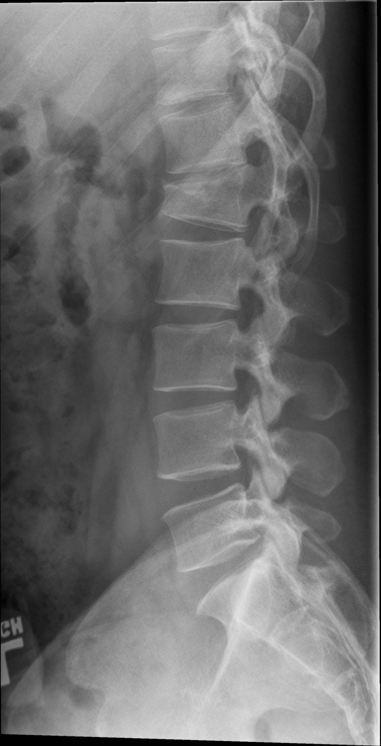 closed fracture of lumbar vertebrae