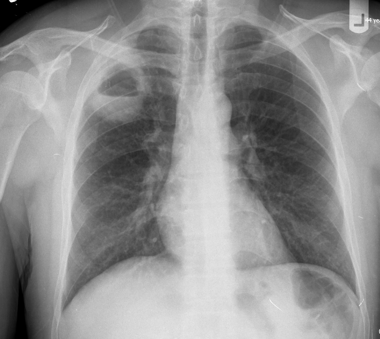 staph pneumonia chest x ray findings