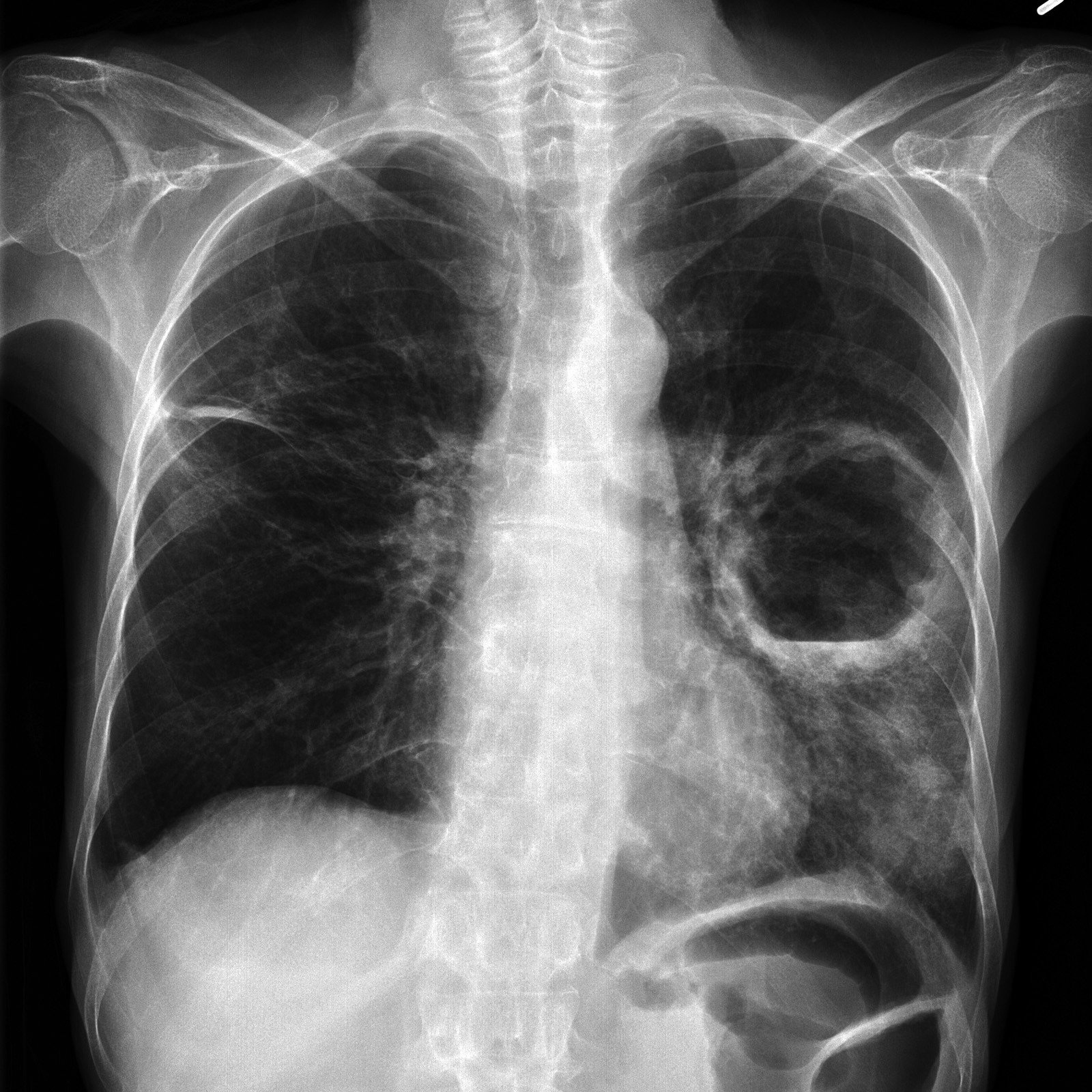 lung-abscess-buyxraysonline