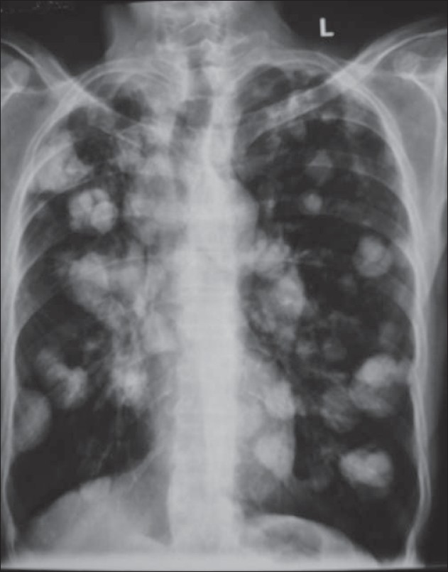 Lung Cancer 2 Buyxraysonline