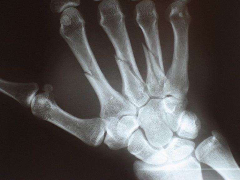 METACARPAL FRACTURE Buyxraysonline