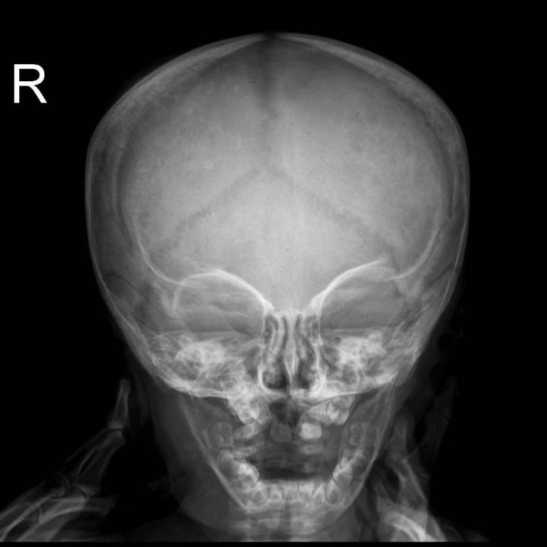 NEUROBLASTOMA | Buyxraysonline