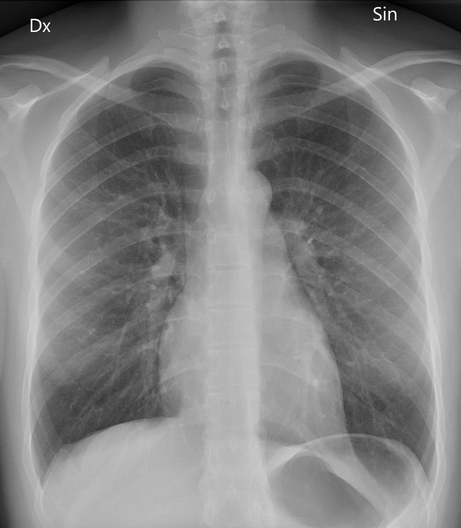 healthy lung xray