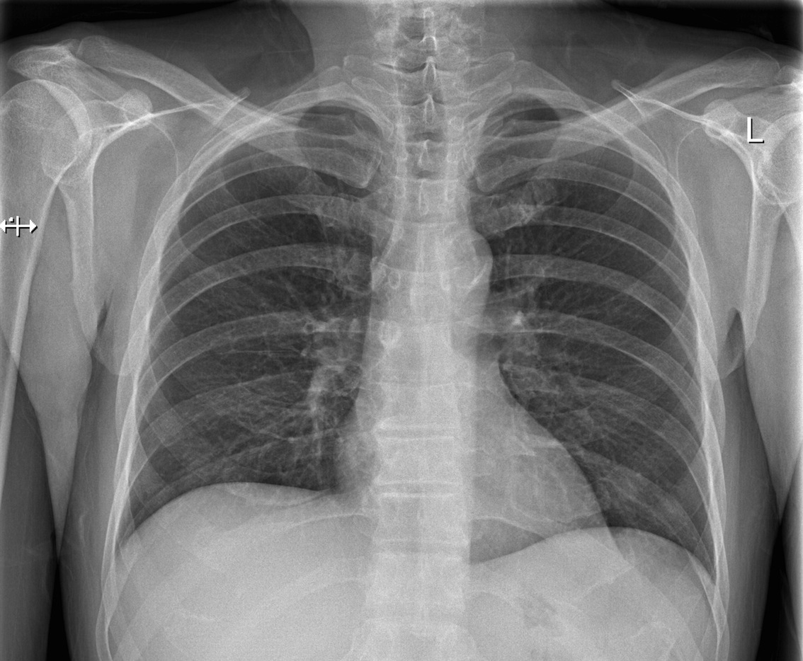 normal chest xray labeled