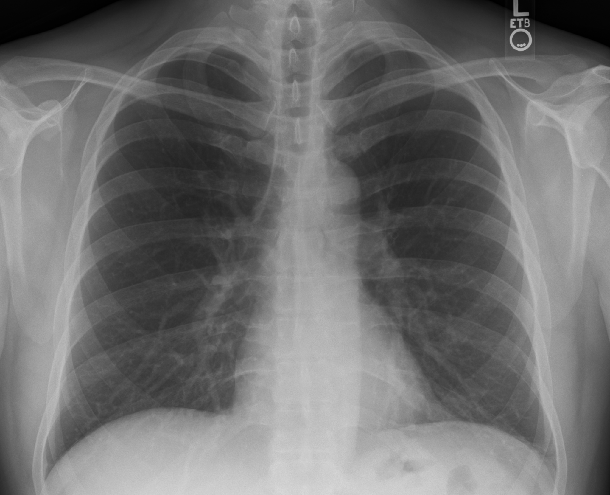 sample normal chest x ray findings for tb test
