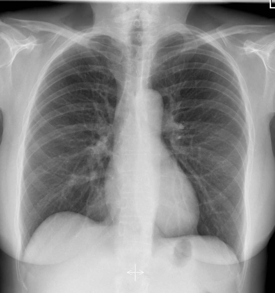 normal chest xray image