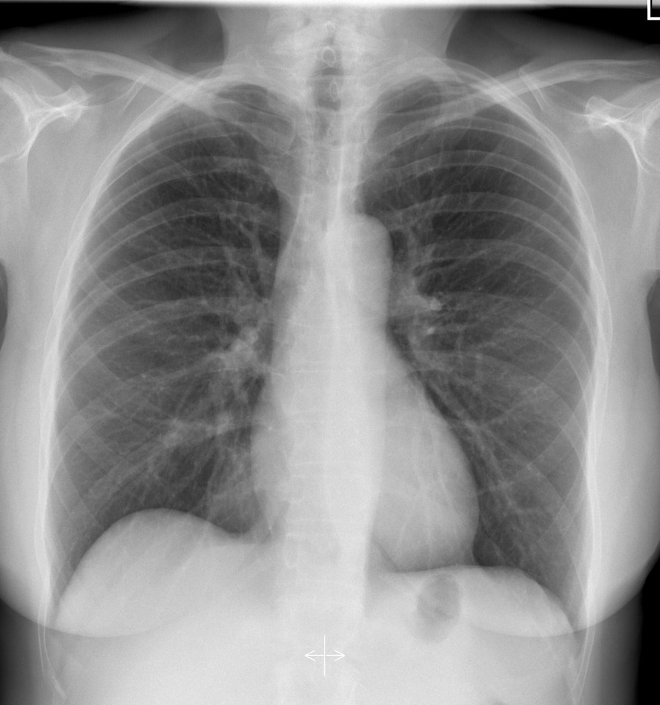 NORMAL CHEST XRAY 5 Buyxraysonline