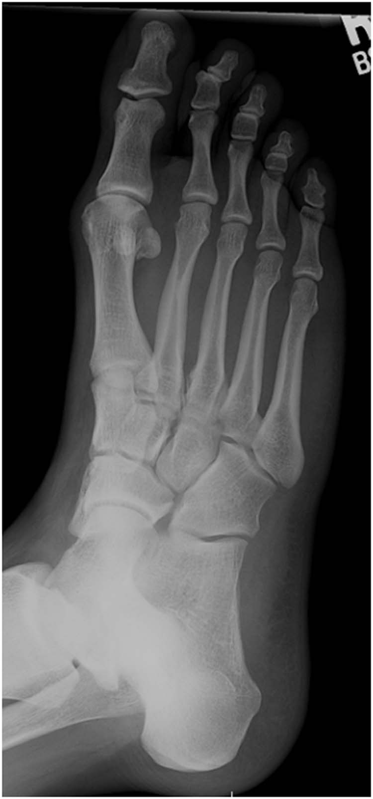 Normal Foot, X-ray Photograph by Du Cane Medical Imaging Ltd