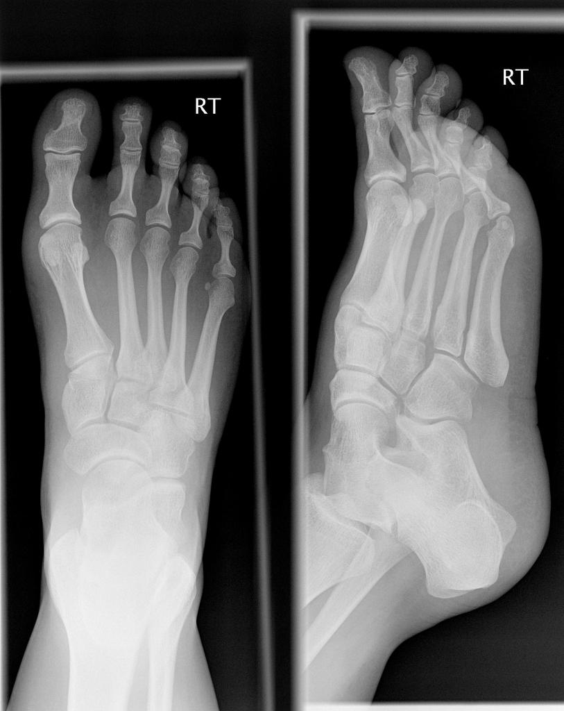 Normal foot, X-ray - Stock Image - C039/3311 - Science 