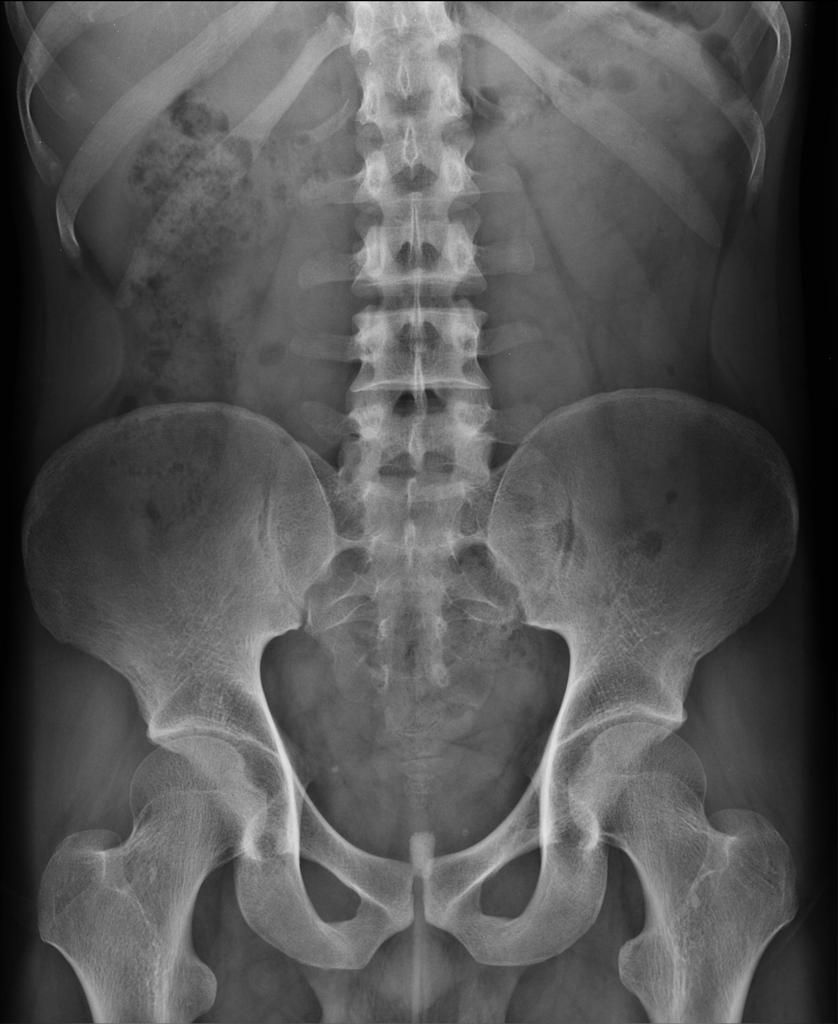 normal hip joint anatomy xray