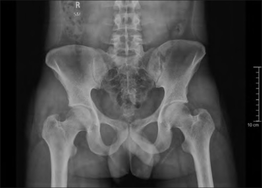 Normal Sacroiliac Joint X Ray