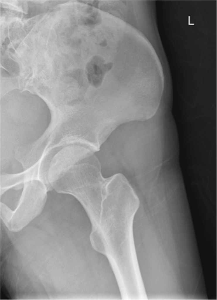 Normal Left Hip Buyxraysonline