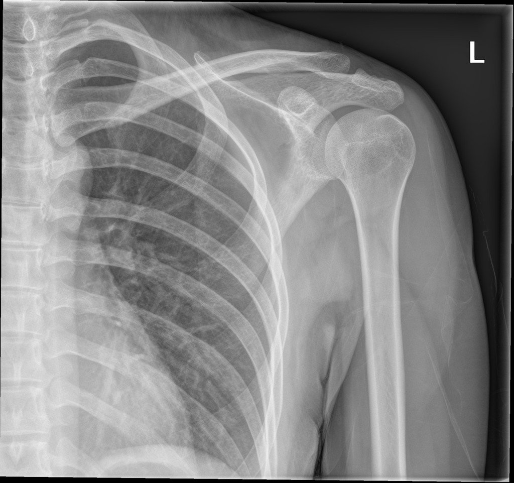 What Does A Normal Shoulder X Ray Look Like At George Hodge Blog What Does A Normal Shoulder X Ray Look Like At George Hodge Blog