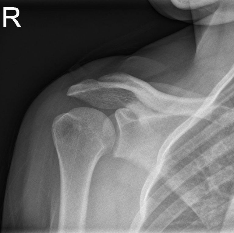 Normal Shoulder 