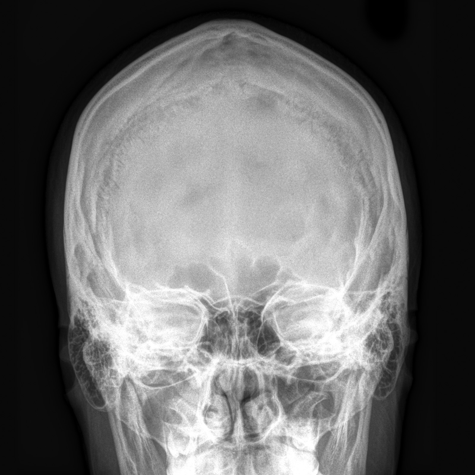 Normal Lateral Skull X Ray