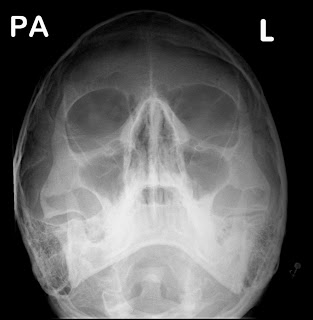 NORMAL LATERAL SKULL-CHILD | Buyxraysonline