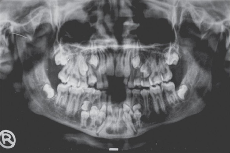 Детский череп рентген. Полиодонтия\ гипердонтия. Гипердонтия зубов рентген.