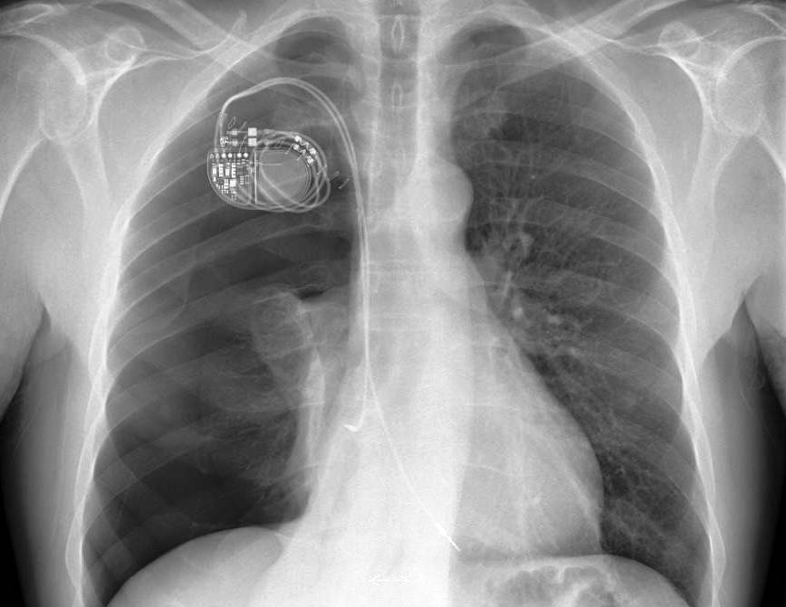 Single chamber icd placement