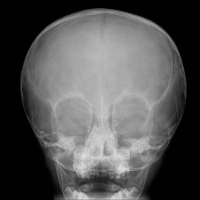 bilateral parietal skull fracture icd 10