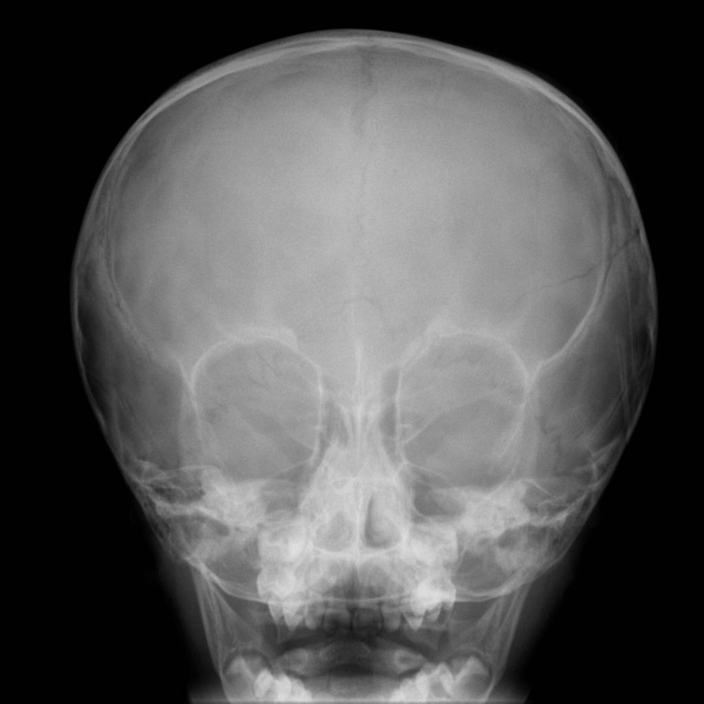 Parietal Skull Fracture Buyxraysonline
