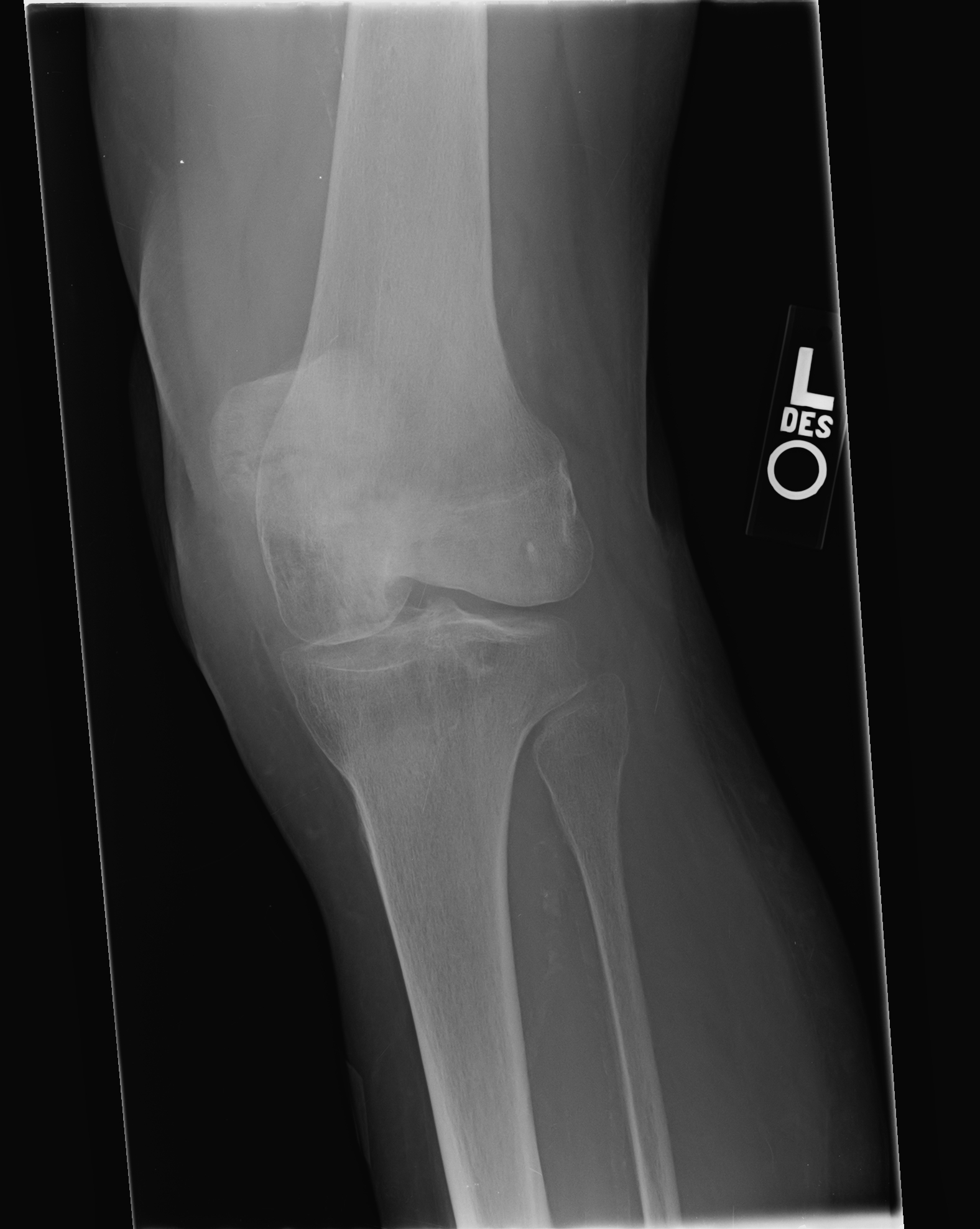 Patella Fracture X Ray